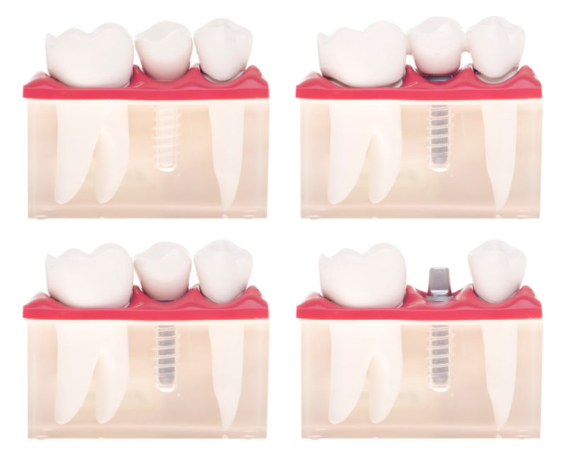 Dental Implants - Mississauga Dentist - Bristol Dental