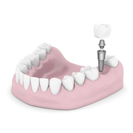 Dental implant - Mississauga Dentist - Bristol Dental