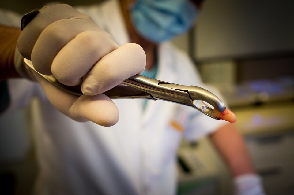 A dentist showing an extracted tooth - Mississauga Dentist - Bristol Dental