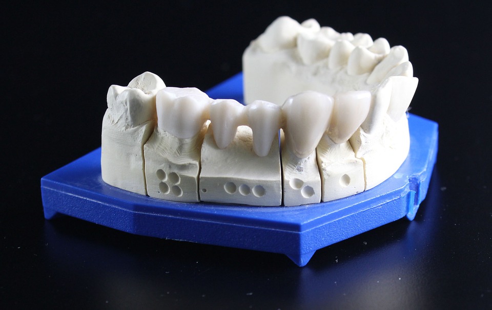 Dental bridge - Mississauga Dentist - Bristol Dental