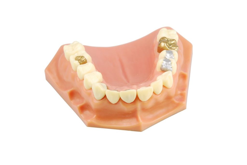 Comparison between inlays and onlays - Mississauga Dentist - Bristol Dental