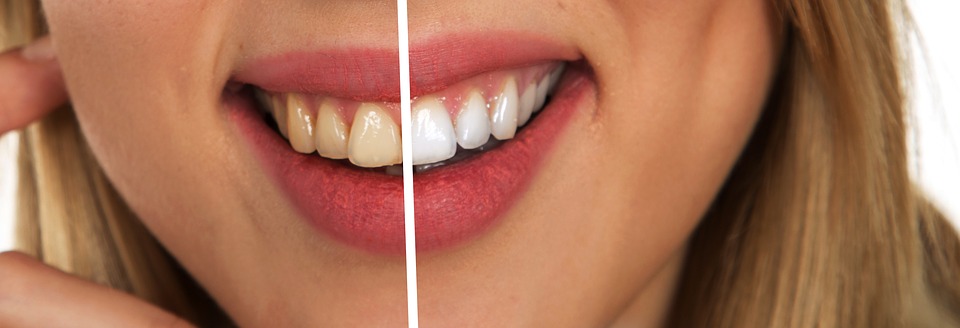 A comparison of teeth before and after teeth whitening - Mississauga Dentist - Bristol Dental