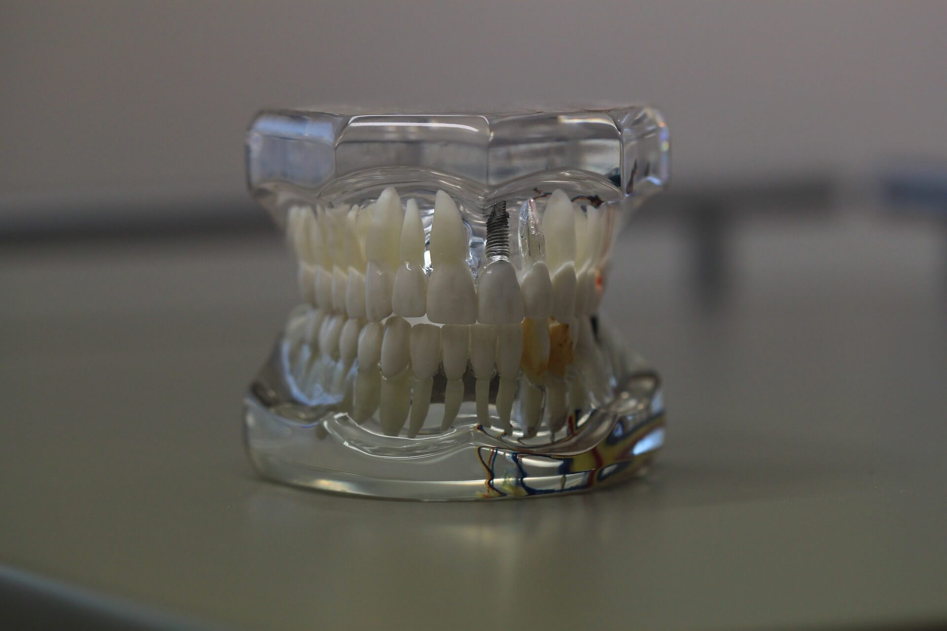 Model teeth - Mississauga Dentist - Bristol Dental