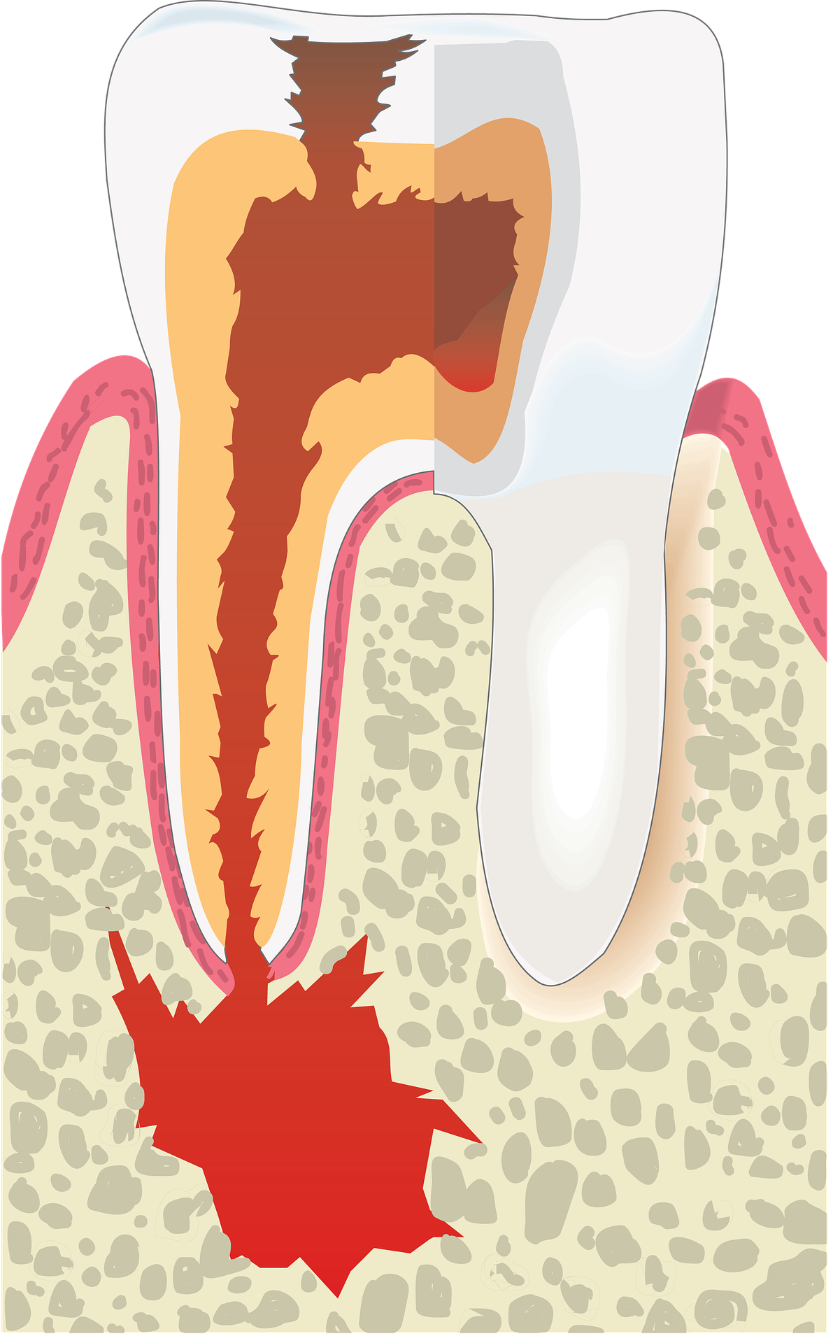 Root canal illustration - Mississauga Dentist - Bristol Dental