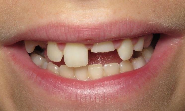 Broken Tooth Mississauga Dentist - Mississauga City Mississauga Dentists - Bristol Dental
