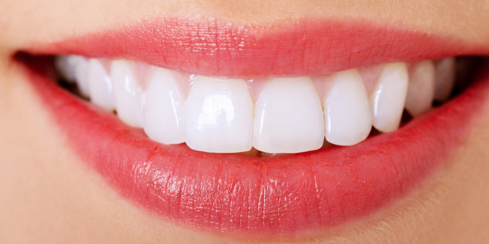 veneers mississauga - dentist mississauga - bristol dental clinic