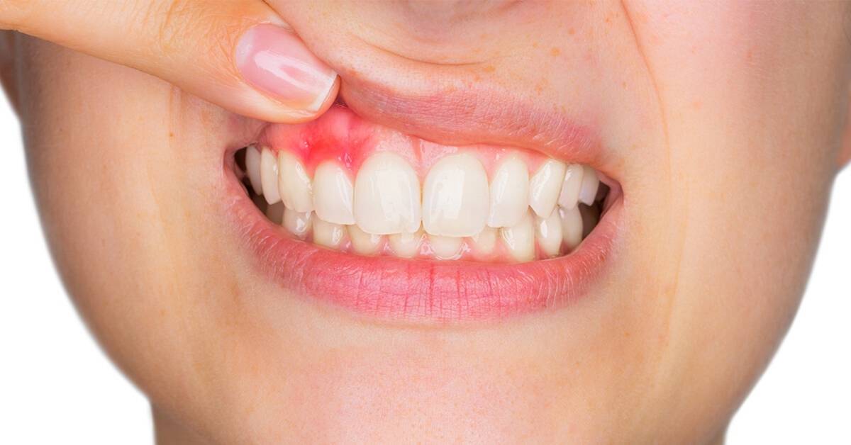 Gum disease mississauga dentist - Bristol Dental Clinic