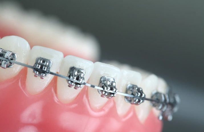Orthodontist in Mississauga - Mississauga Dentists - Bristol Dental Care