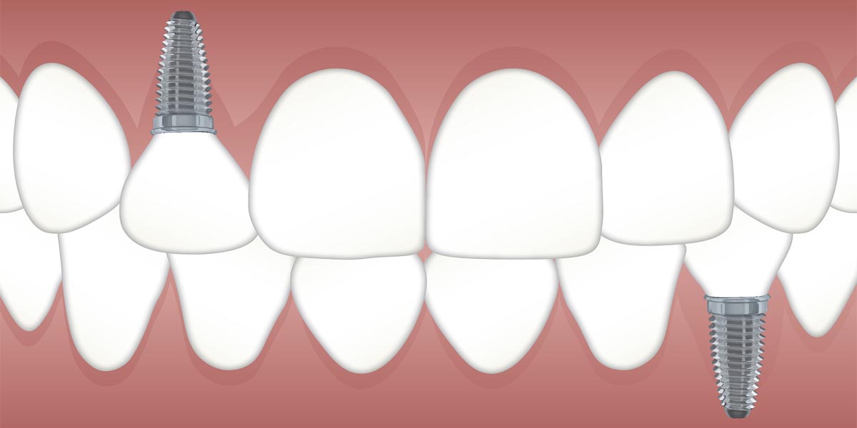 Dental Implant Process - Mississauga Dentist - Bristol Dental Care