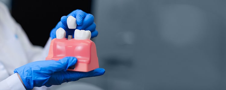 5 Benefits of Dental Implants