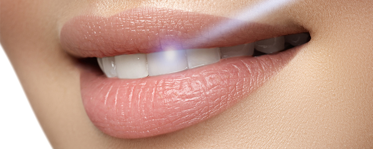 6 Things You Need to Know About Laser Teeth Whitening