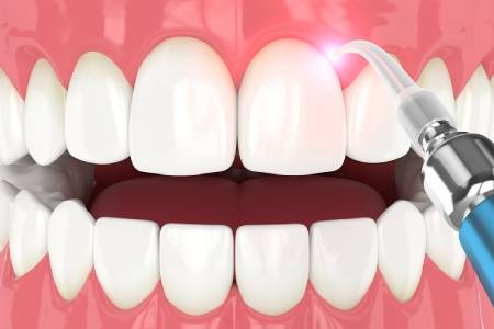 Gum Contouring Surgery