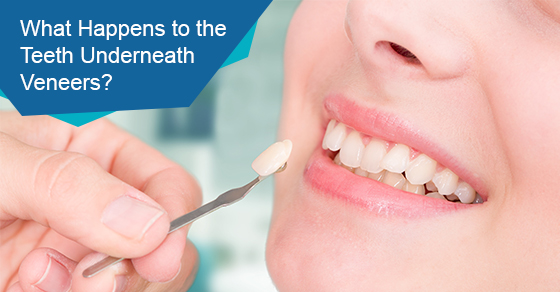 What happens to the teeth underneath veneers?