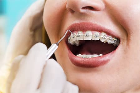traditional braces - Mississauga Dentist - Bristol Dental