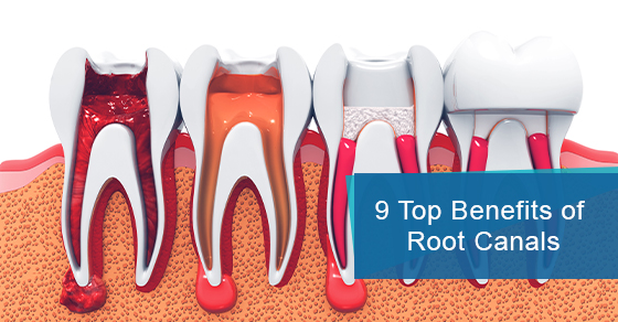 9 Top Benefits of Root Canals