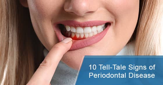 Signs of periodontal disease