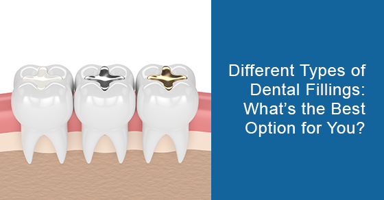 Types of dental fillings