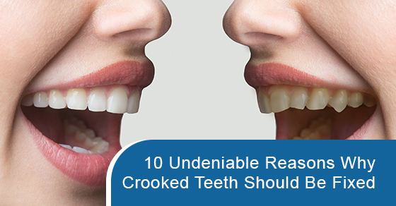 Undeniable reasons why crooked teeth should be fixed
