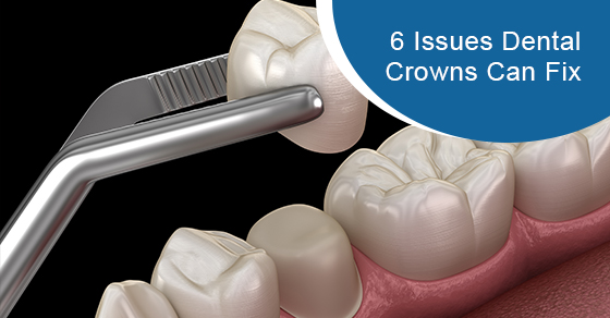 6 issues dental crowns can fix