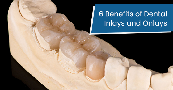 6 benefits of dental inlays and onlays