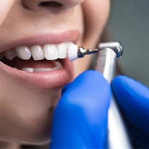 Teeth Cleaning Services in Mississauga