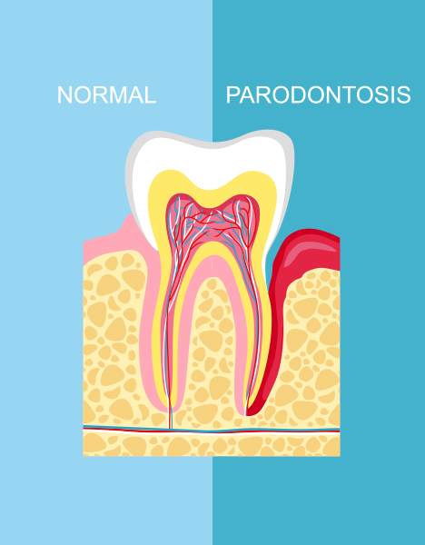 Periodontal Treatment in Mississauga