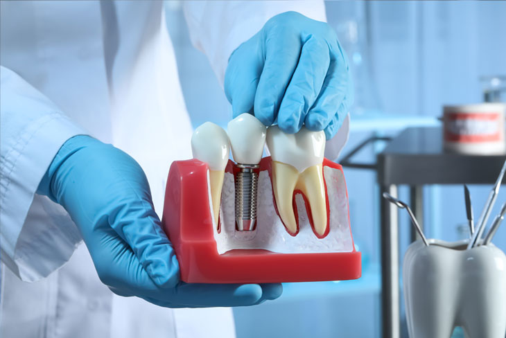 Benefits of Prosthodontic Treatments