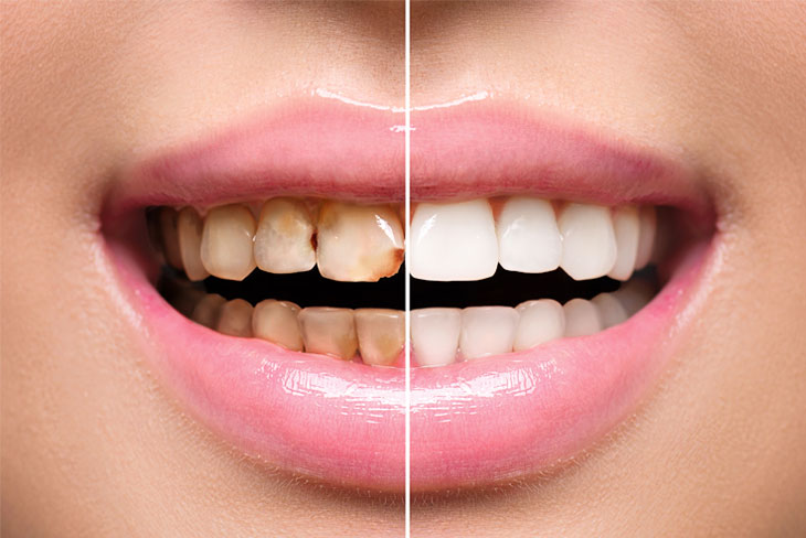 Restorative Dentistry Services Mississauga