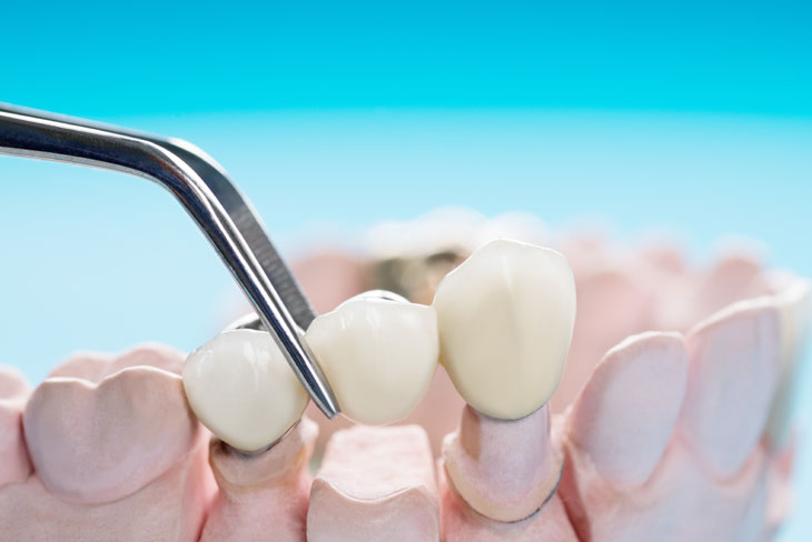 Dental Prosthodontic Mississauga