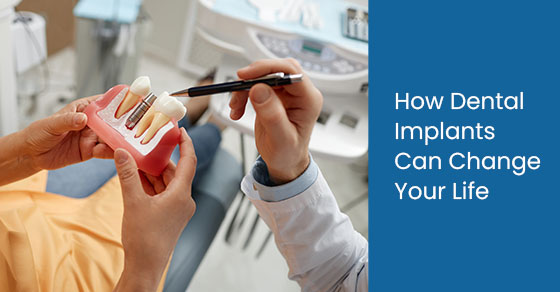 How dental implants can change your life