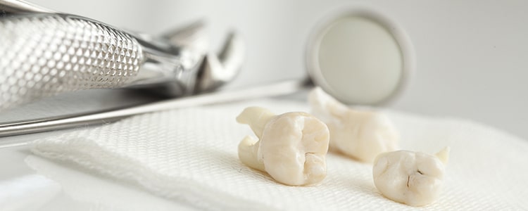 Signs You Need to Get Your Wisdom Teeth Removed