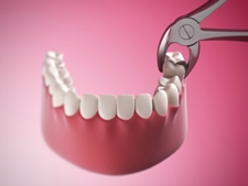 Tooth extraction - Mississauga Dentist - Bristol Dental